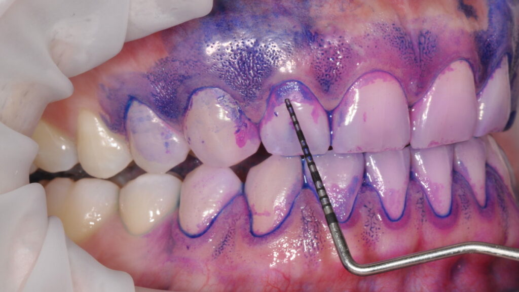 Disclosing teeth to show plaque as part of the Guided Biofilm Therapy protocol